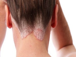 Psoriasis-dermatologie-Dr Rafii Nadia, votre Dermatologue à Molenbeek