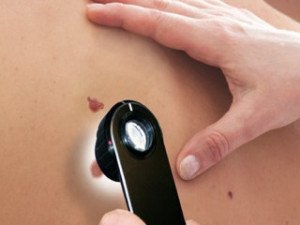 Mélanome-dermatologie