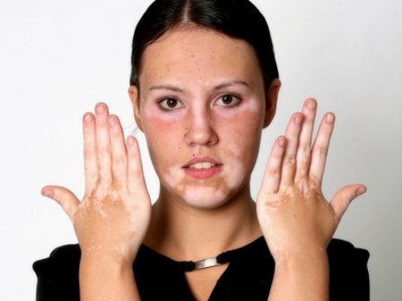 Vitiligo - Dermatologie - Dr Rafii Nadia votre Dermatologue à ...